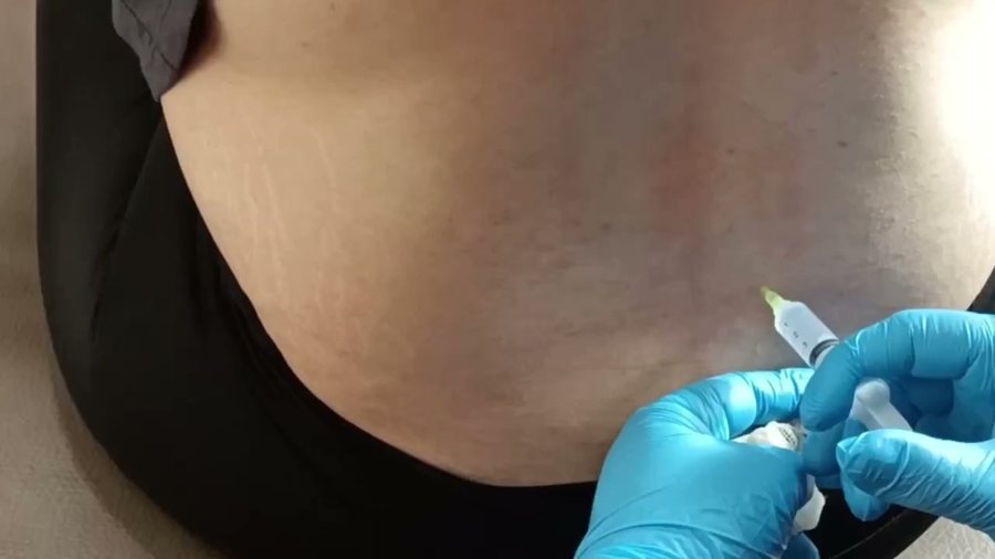 Prolotherapy injection